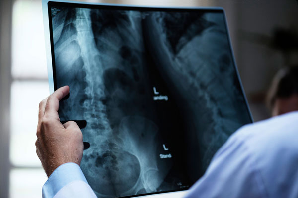 Spinal cord injury