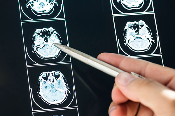 Traumatic brain injury